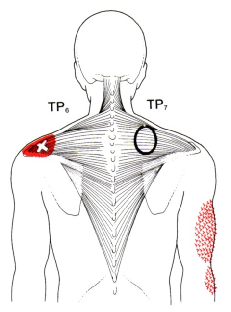 Trapezius | The Trigger Point & Referred Pain Guide